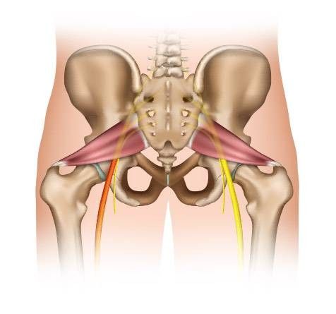 Sindrome del piriforme - cos'è