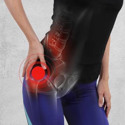 Sintomi della borsite trocanterica