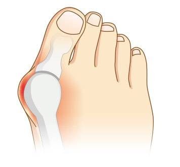 Alluce valgo - cos'è
