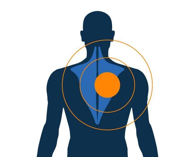 Contrattura del trapezio