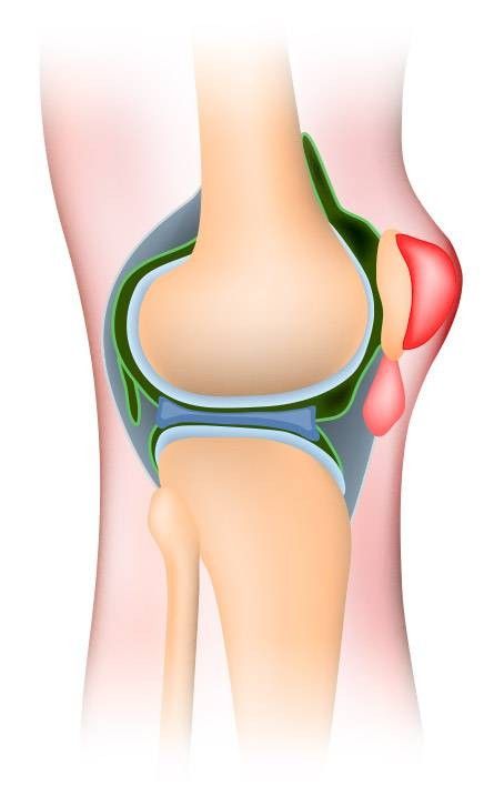 Borsite del ginocchio - cause