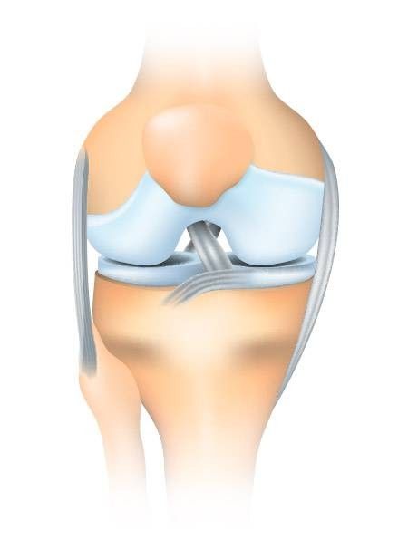 Artrosi al ginocchio - cos'è