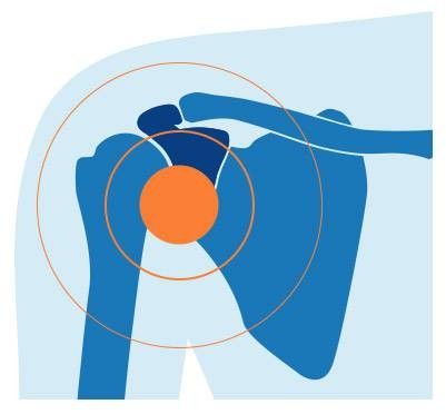 Dolore alla scapola - cause