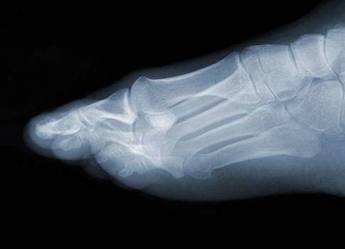 Radiografia piede