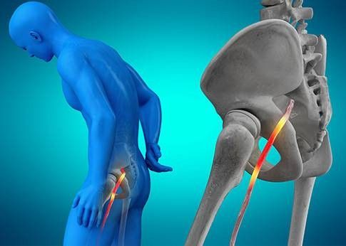 infografica del nervo sciatico