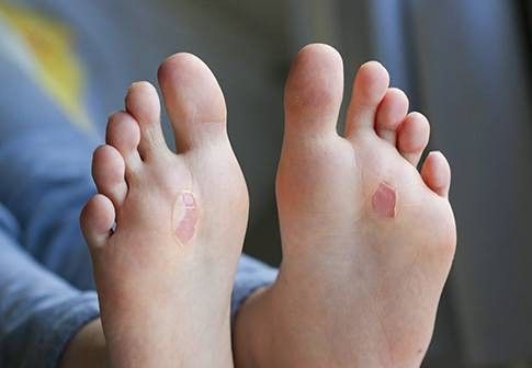 Dolore pianta del piede: come combattere il dolore plantare - AIM