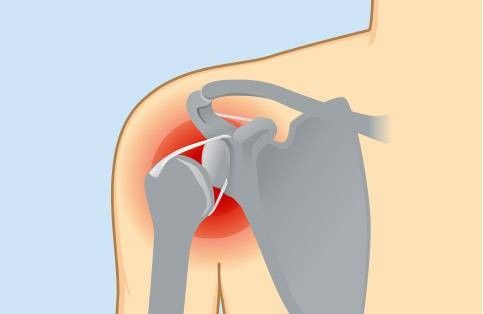 Lussazione della spalla - cause