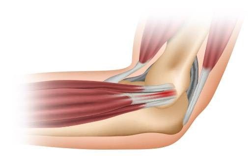 Gomito del tennista - cos'è