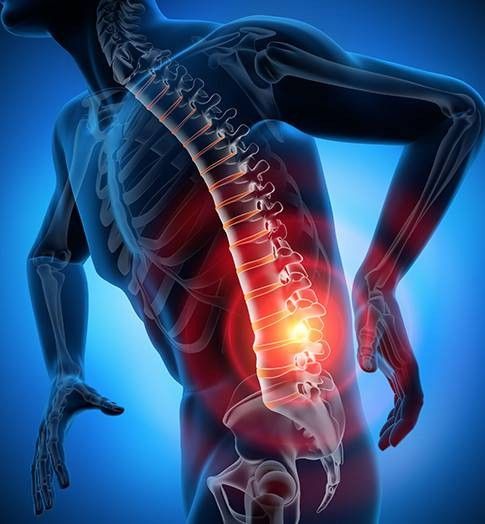 infografica di ernia al disco